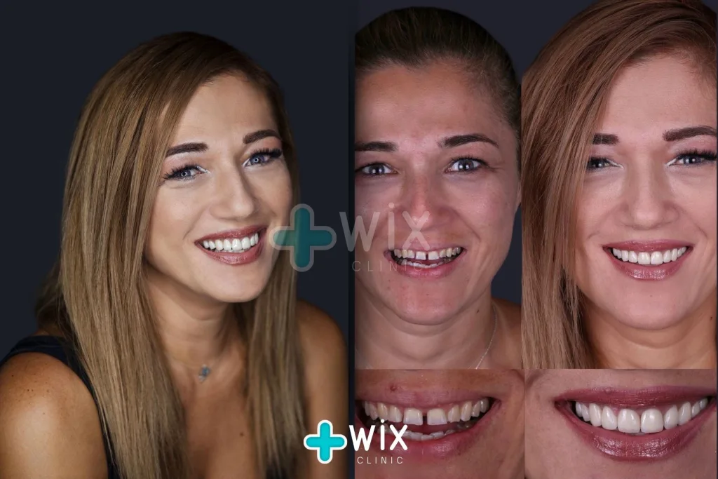 Hollywood Smile Before and After