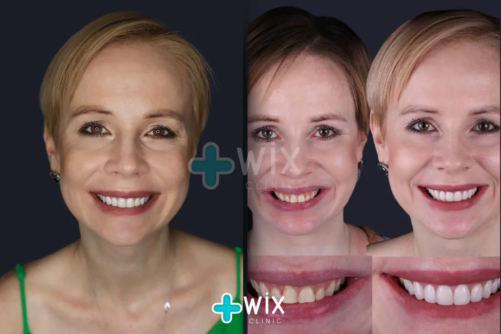 Hollywood Smile Before and After