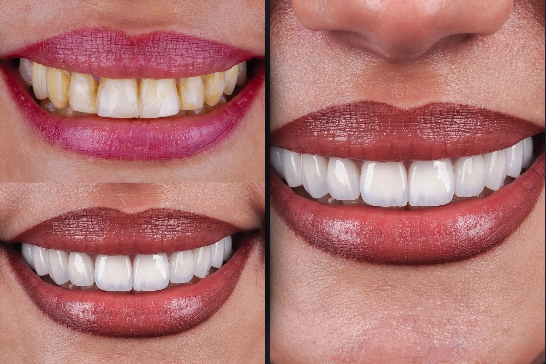 Dental Crown Before and After