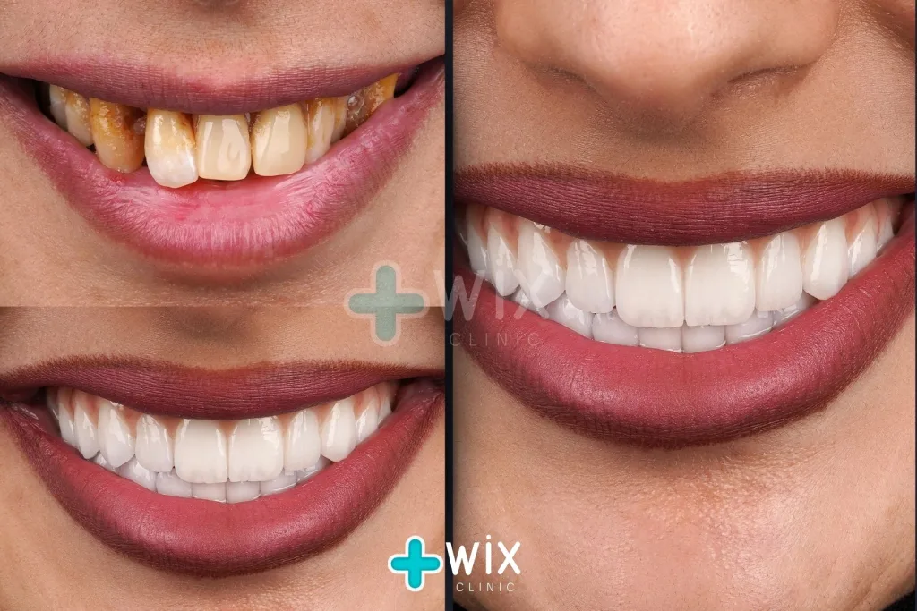 Hollywood Smile Before and After