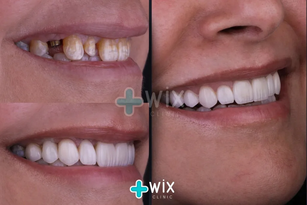 Hollywood Smile Before and After