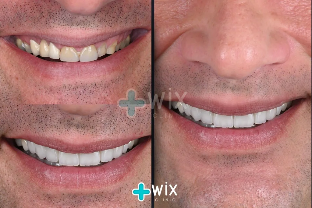 Hollywood Smile Before and After