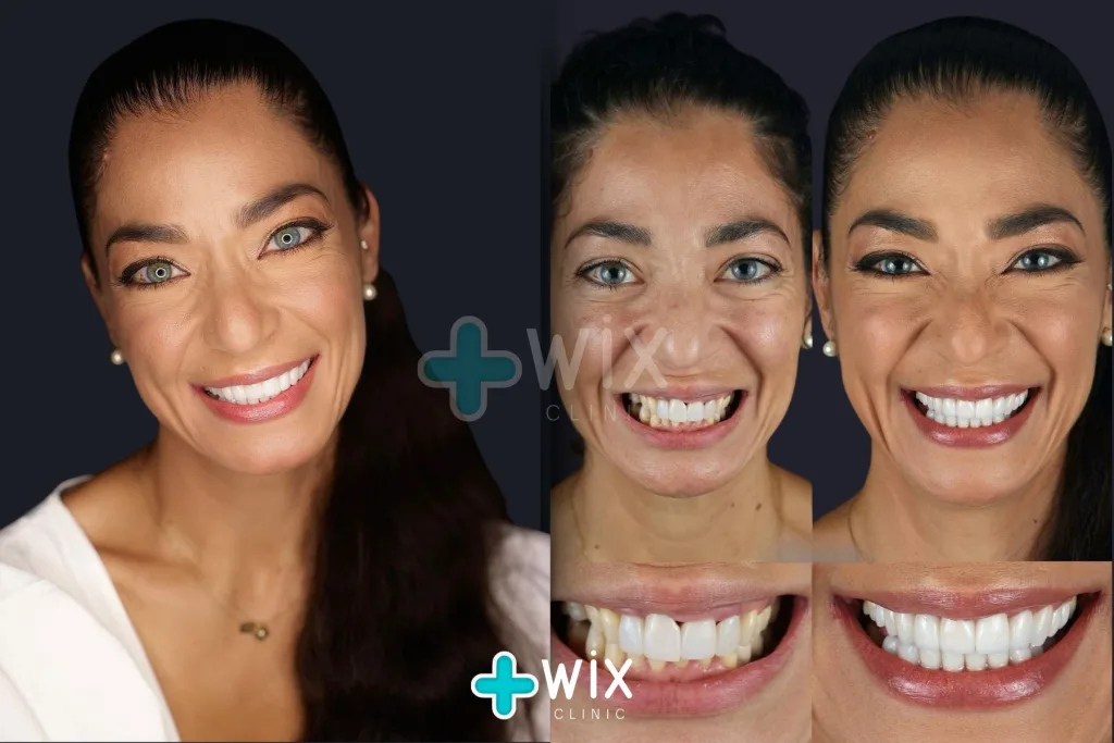 Hollywood Smile Before and After