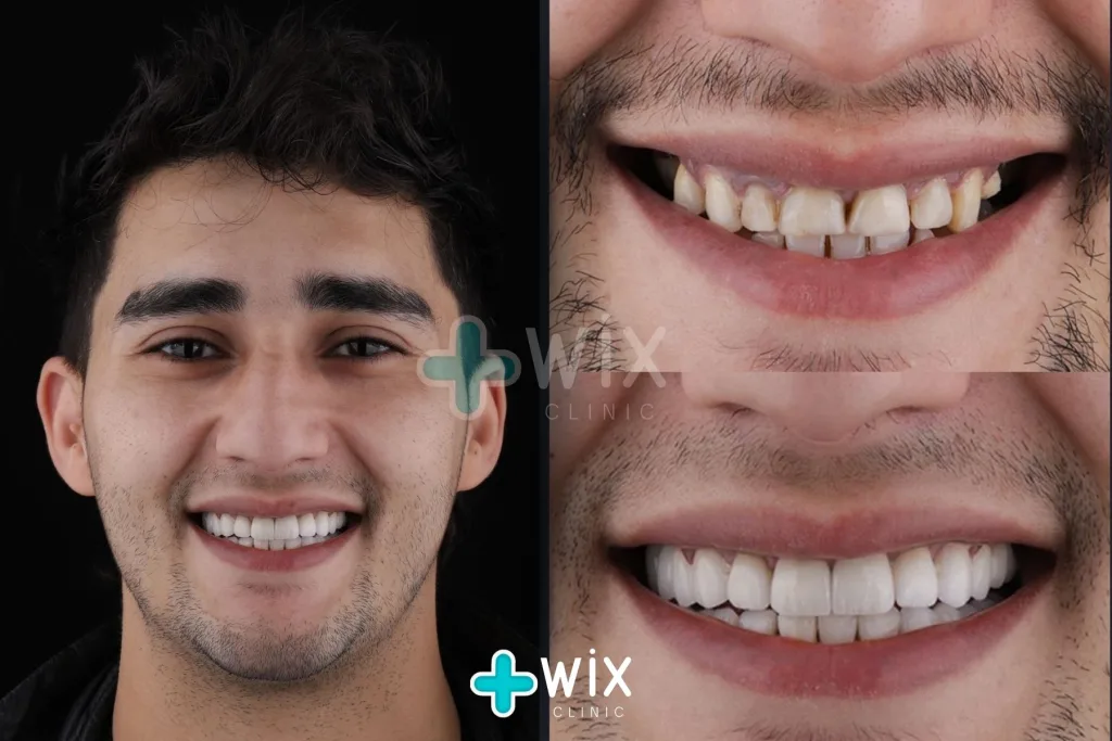 Hollywood Smile Before and After