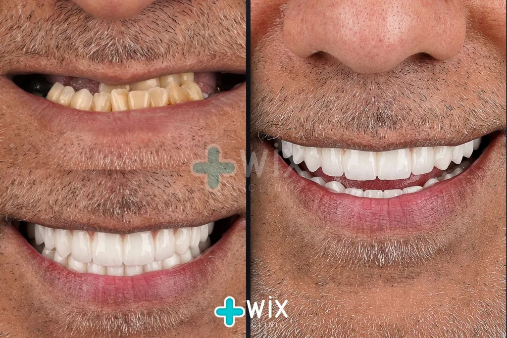 Hollywood Smile Before and After