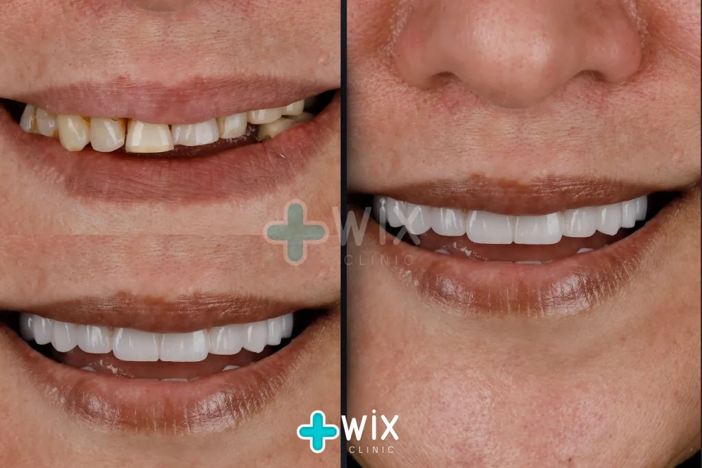 Hollywood Smile Before and After