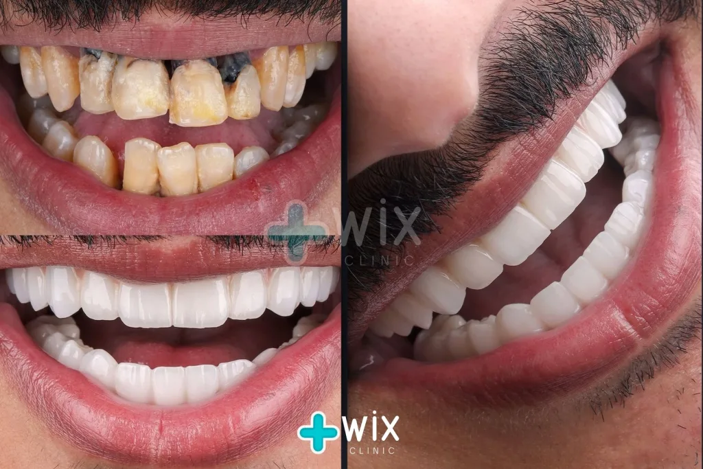 Hollywood Smile Before and After