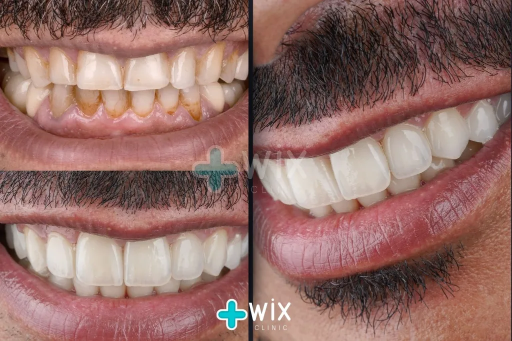 Hollywood Smile Before and After