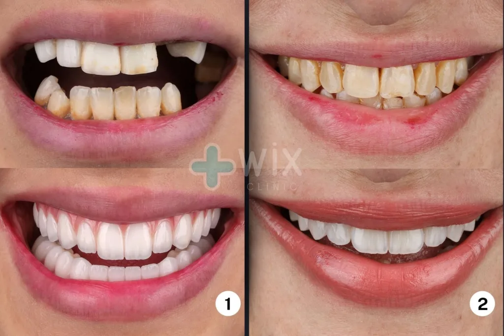 Hollywood Smile Before and After