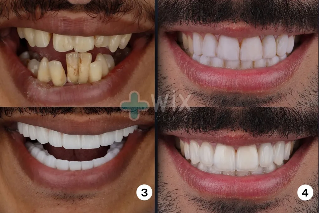 Hollywood Smile Before and After