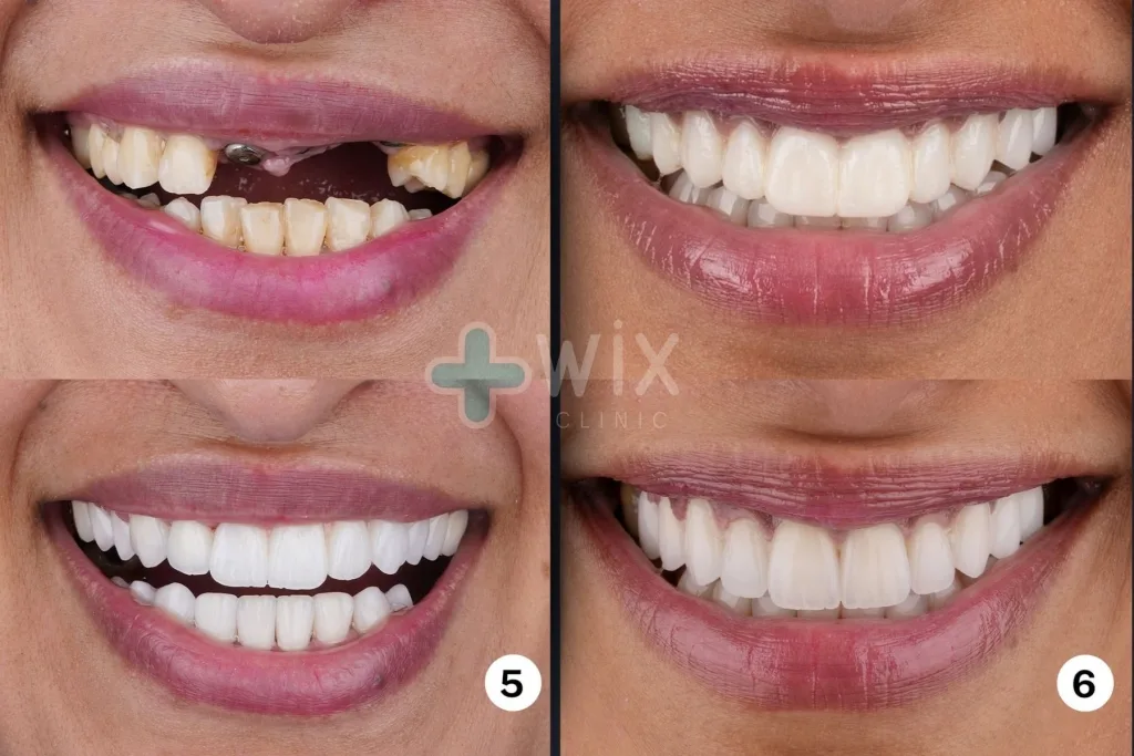 Hollywood Smile Before and After