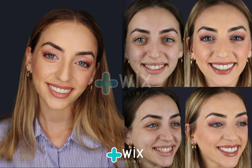 Hollywood Smile Before and After