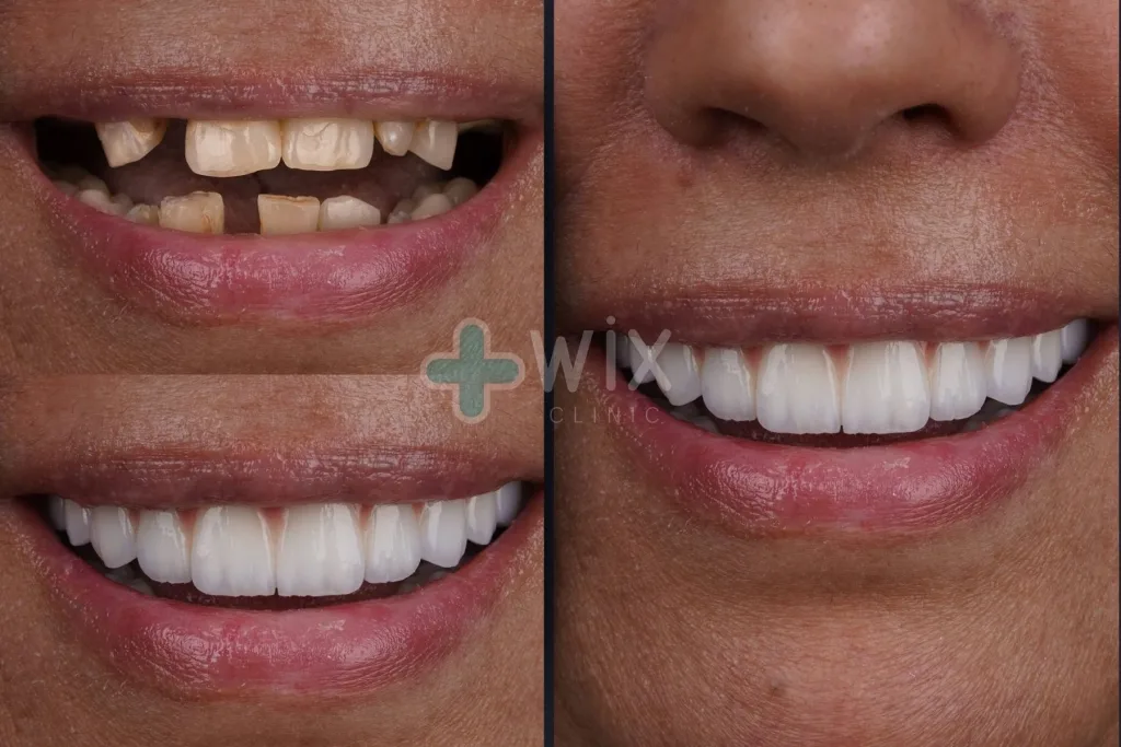 Hollywood Smile Before and After