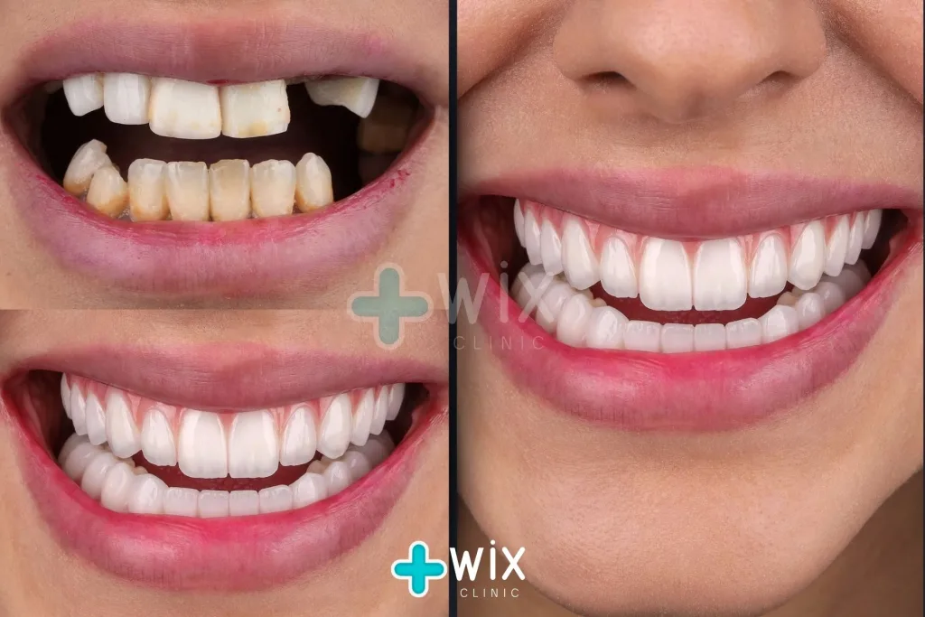 Dental Implants Before and After