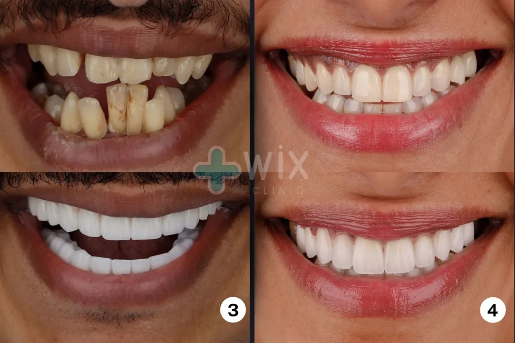 Hollywood Smile Before and After