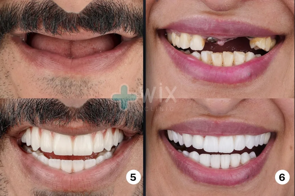 Hollywood Smile Before and After