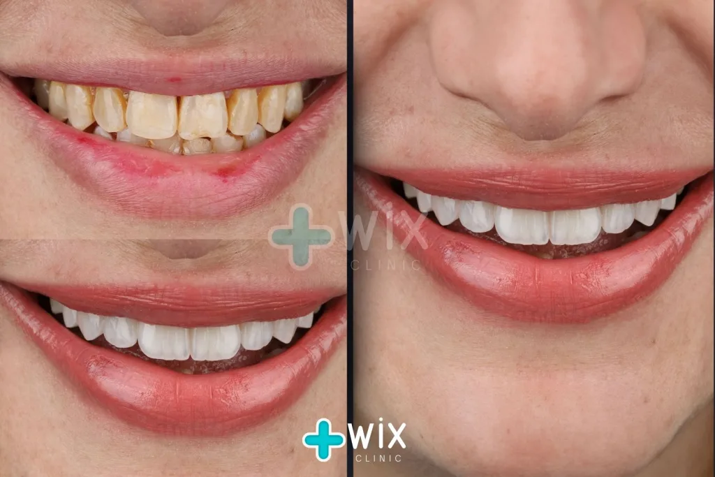 Hollywood Smile Before and After