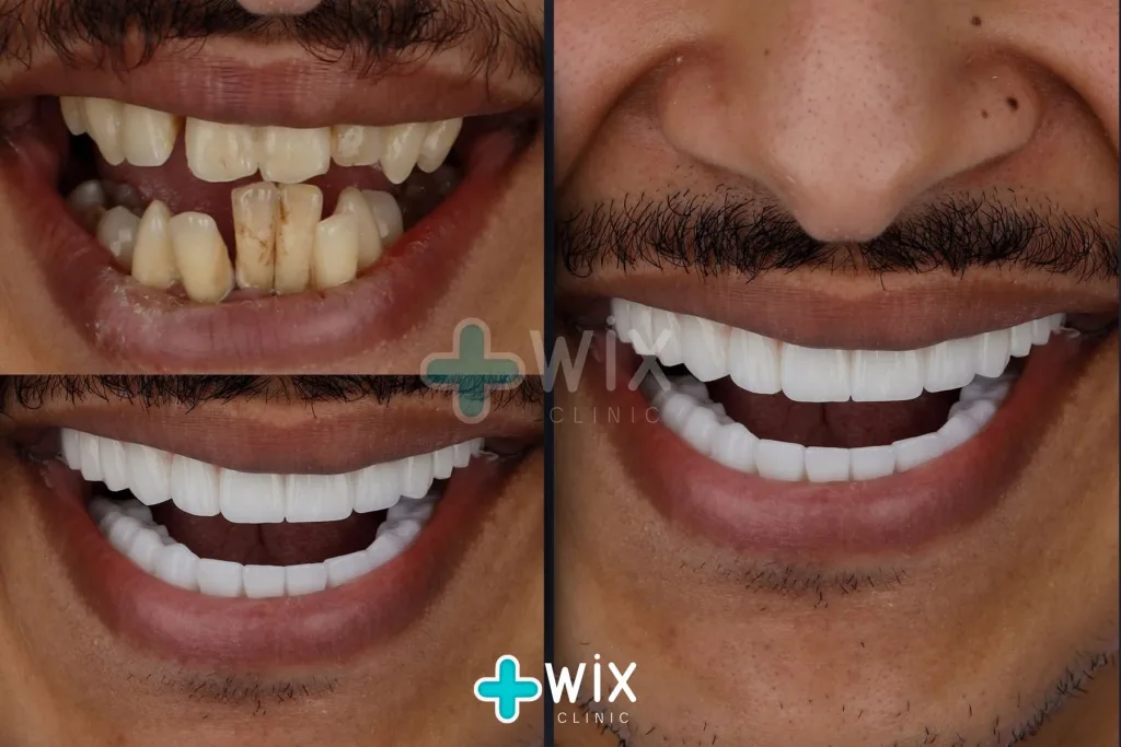 Hollywood Smile Before and After