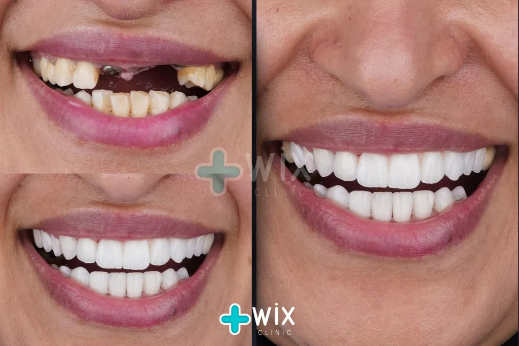 Hollywood Smile Before and After