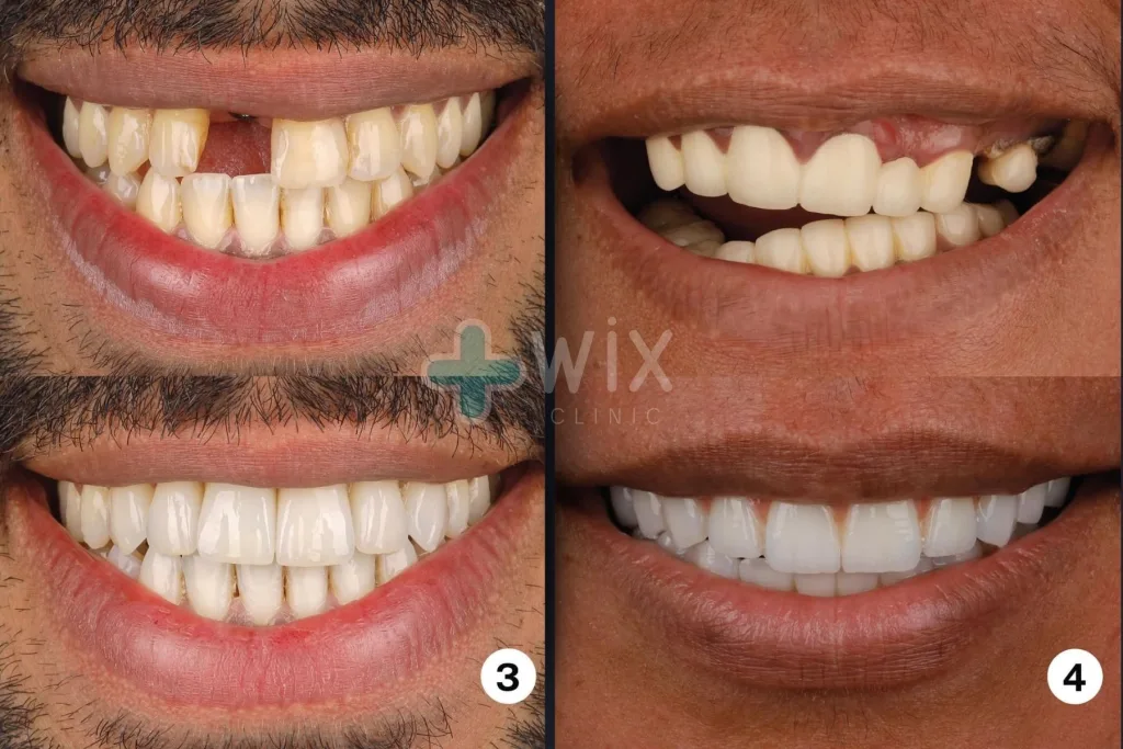 Hollywood Smile Before and After