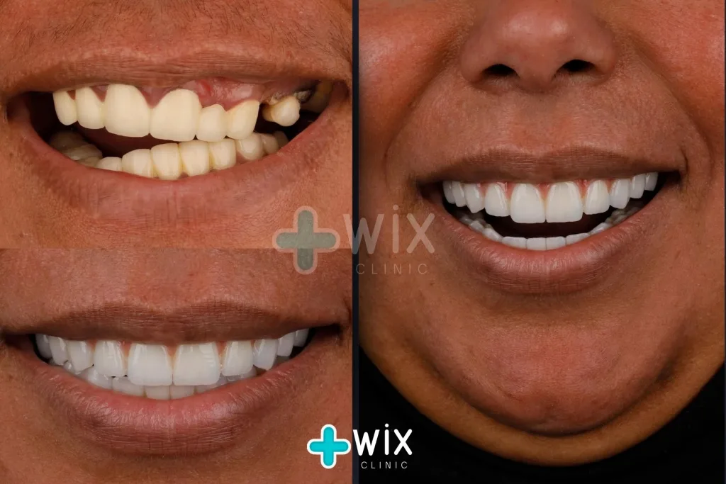 Hollywood Smile Before and After