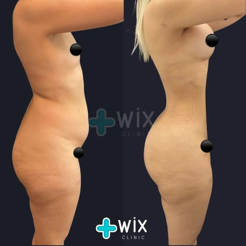 Liposuction Before and After