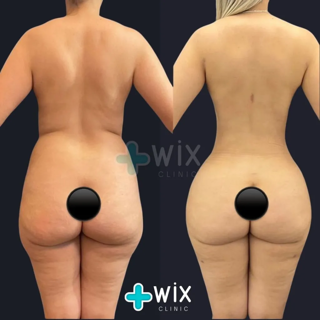 Liposuction Before and After