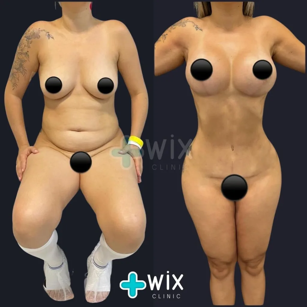 Liposuction Before and After