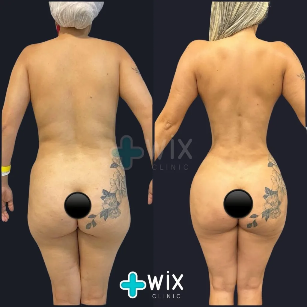 Liposuction Before and After