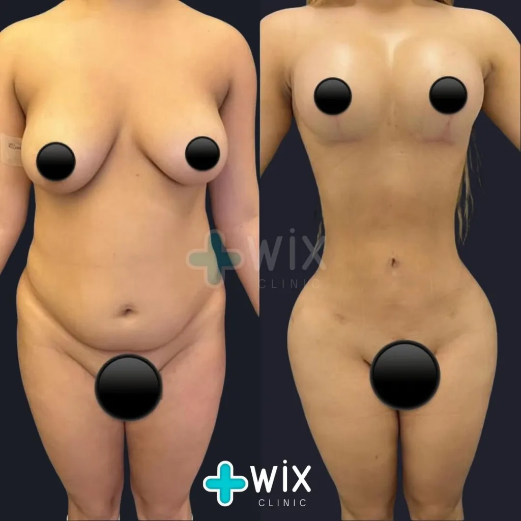 Liposuction Before and After