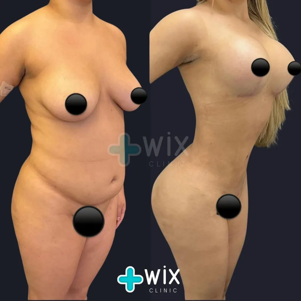 Liposuction Before and After