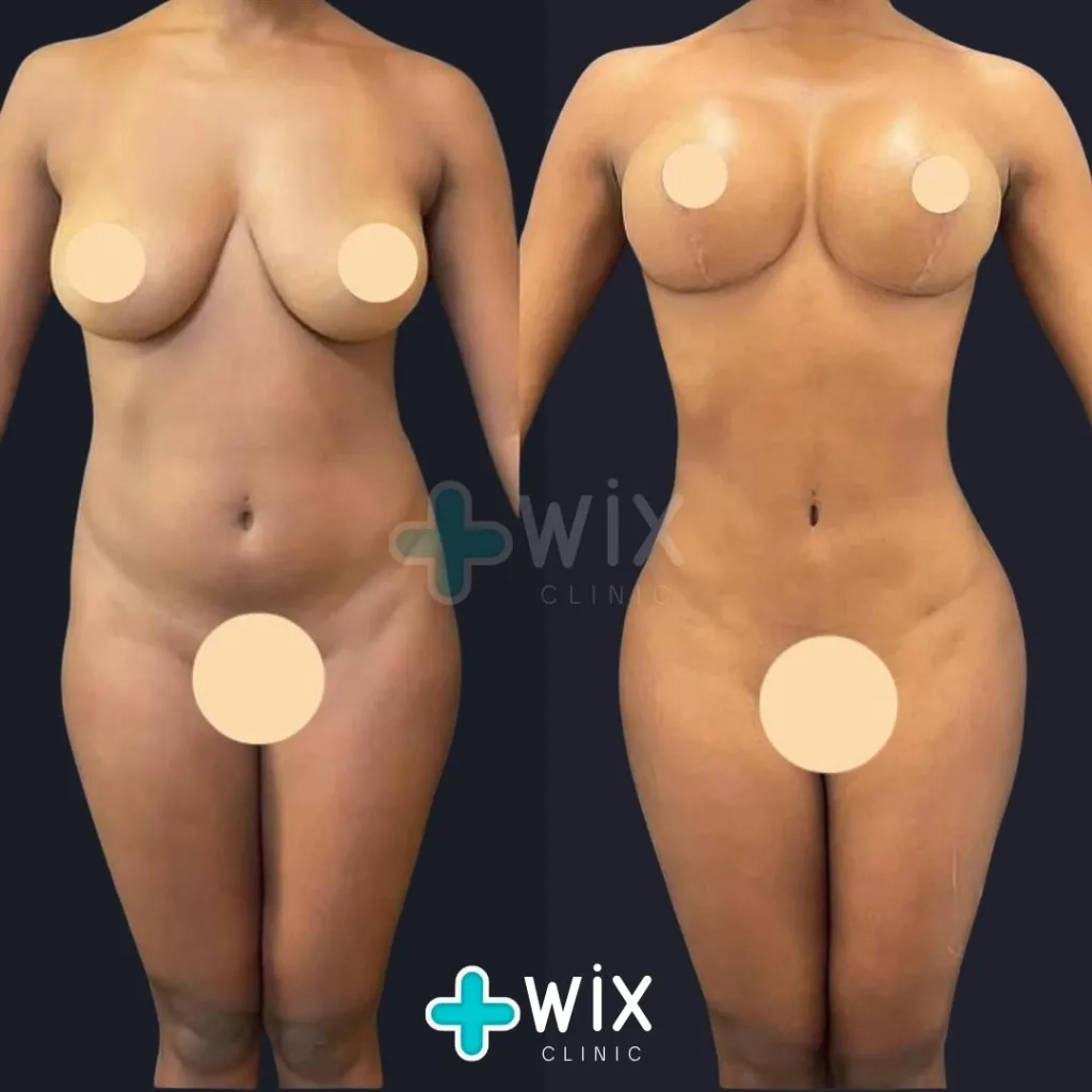 Liposuction Before and After