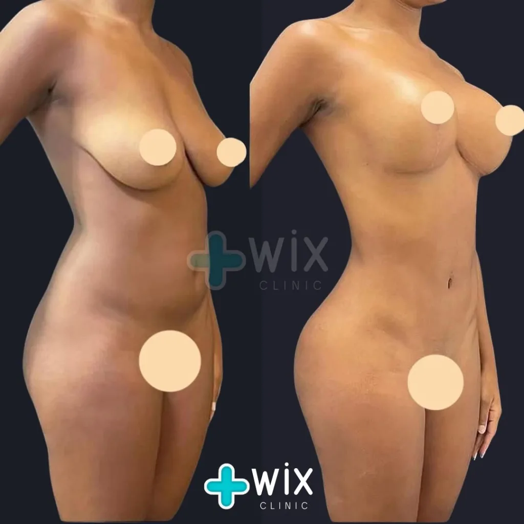 Liposuction Before and After