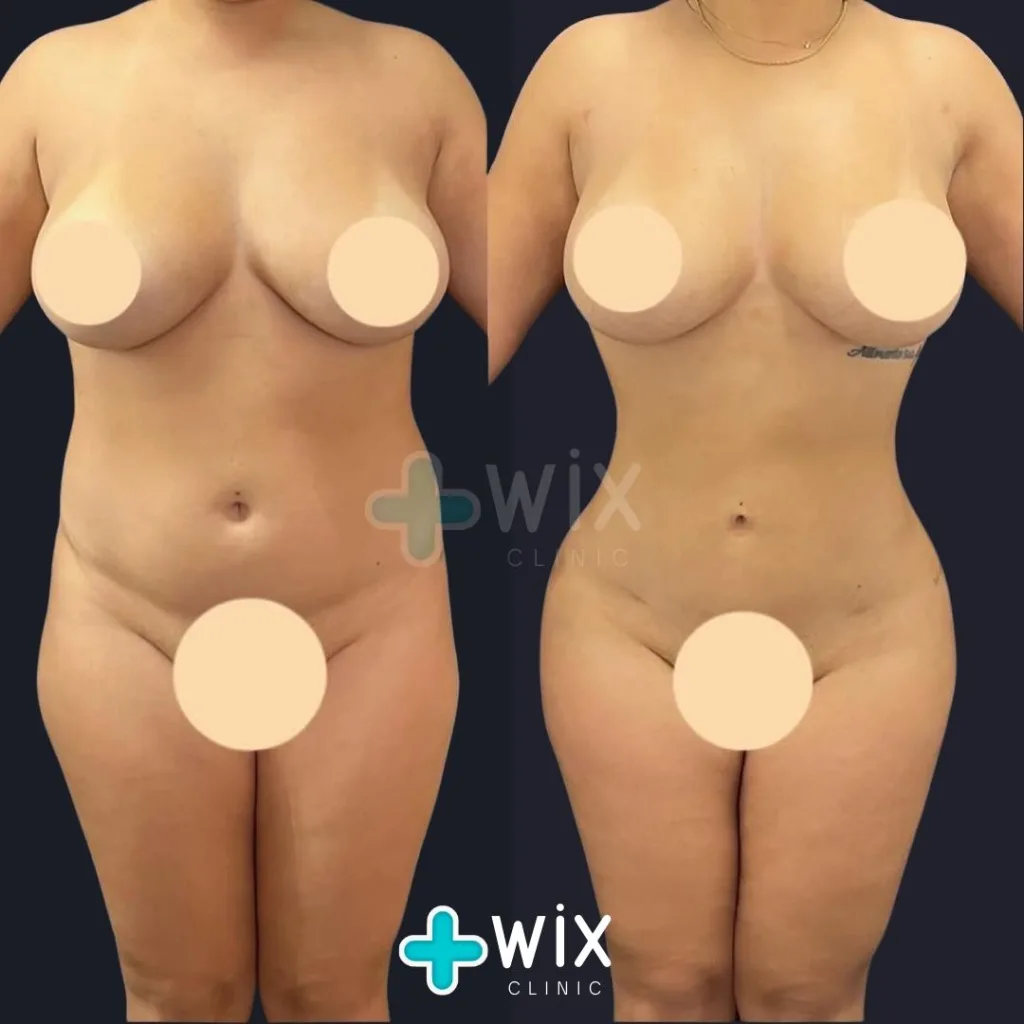 Liposuction Before and After