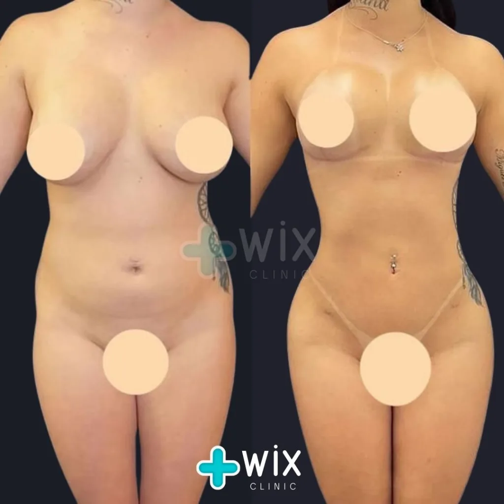 Liposuction Before and After