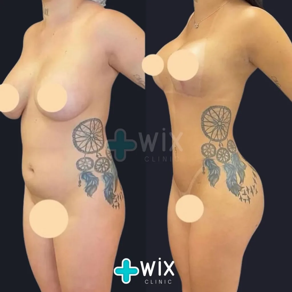 Liposuction Before and After