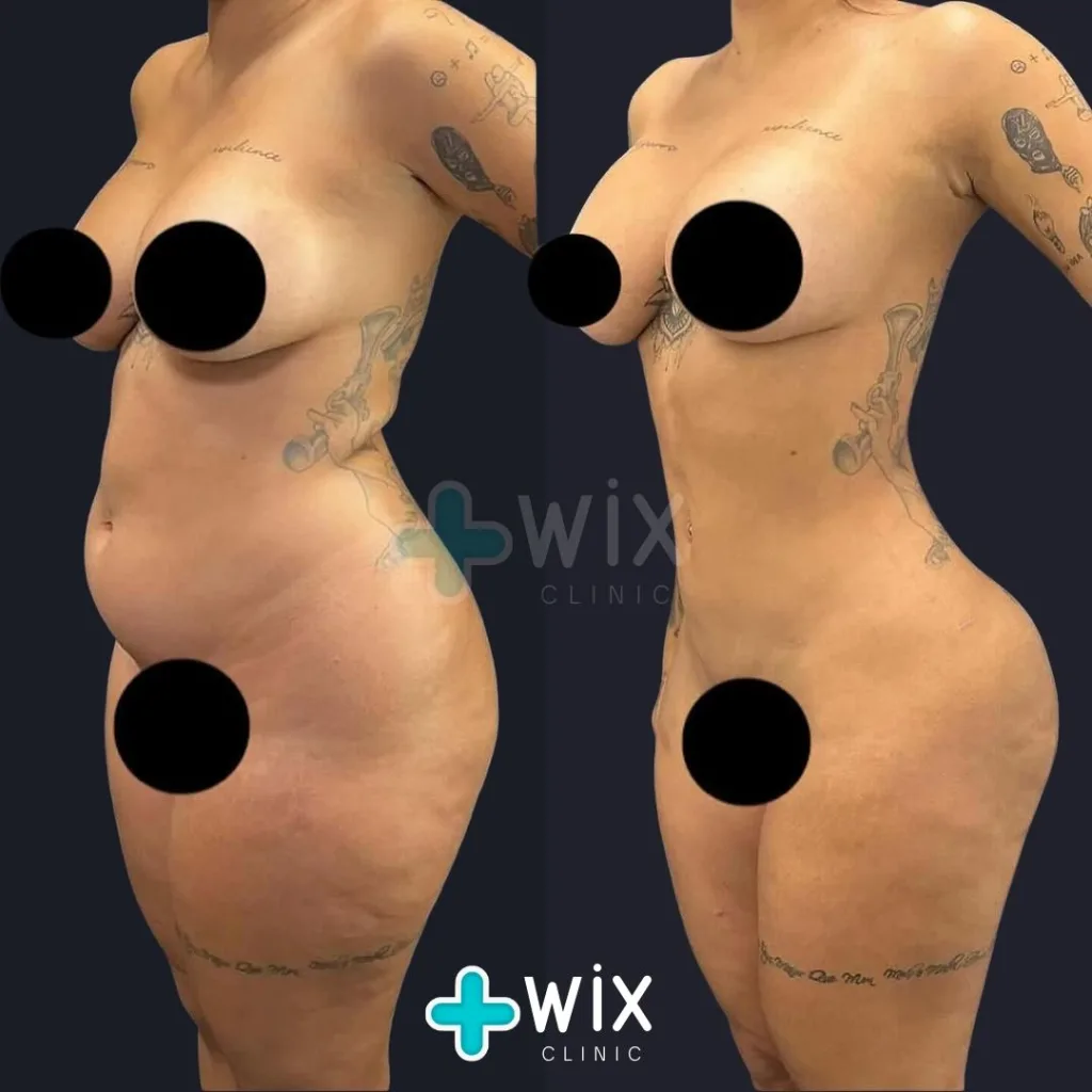 Liposuction Before and After