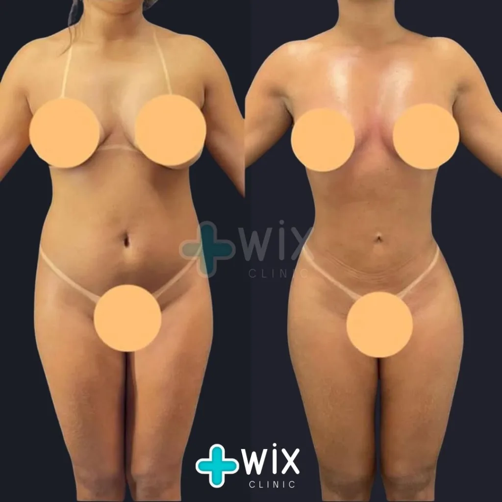 Liposuction Before and After