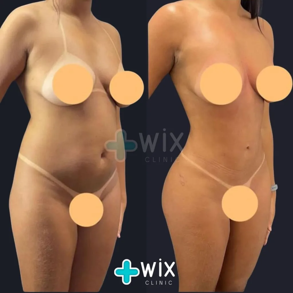 Liposuction Before and After