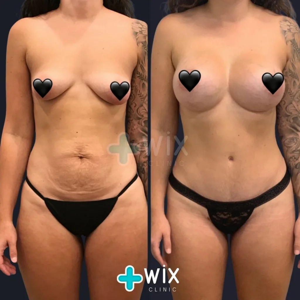 Liposuction Before and After