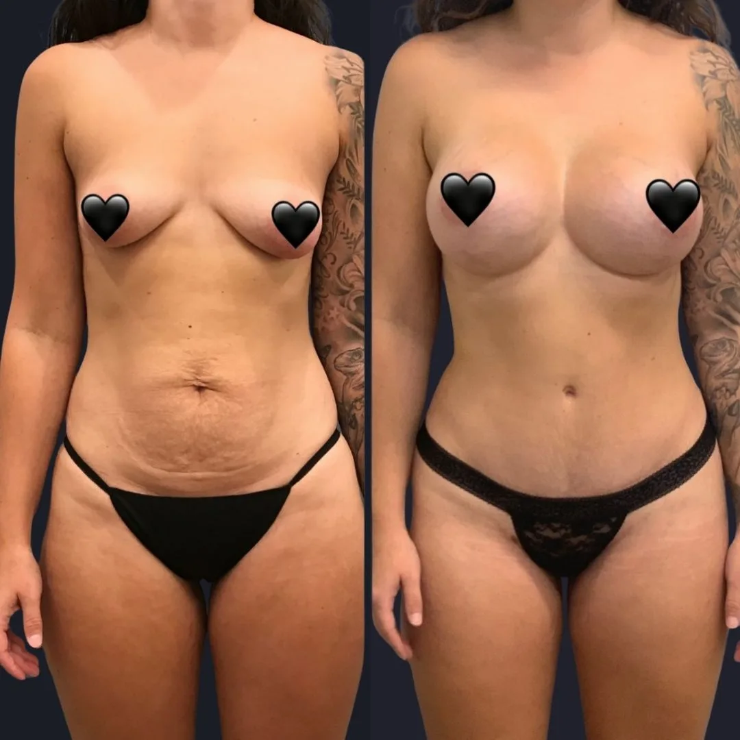 Liposuction Before and After