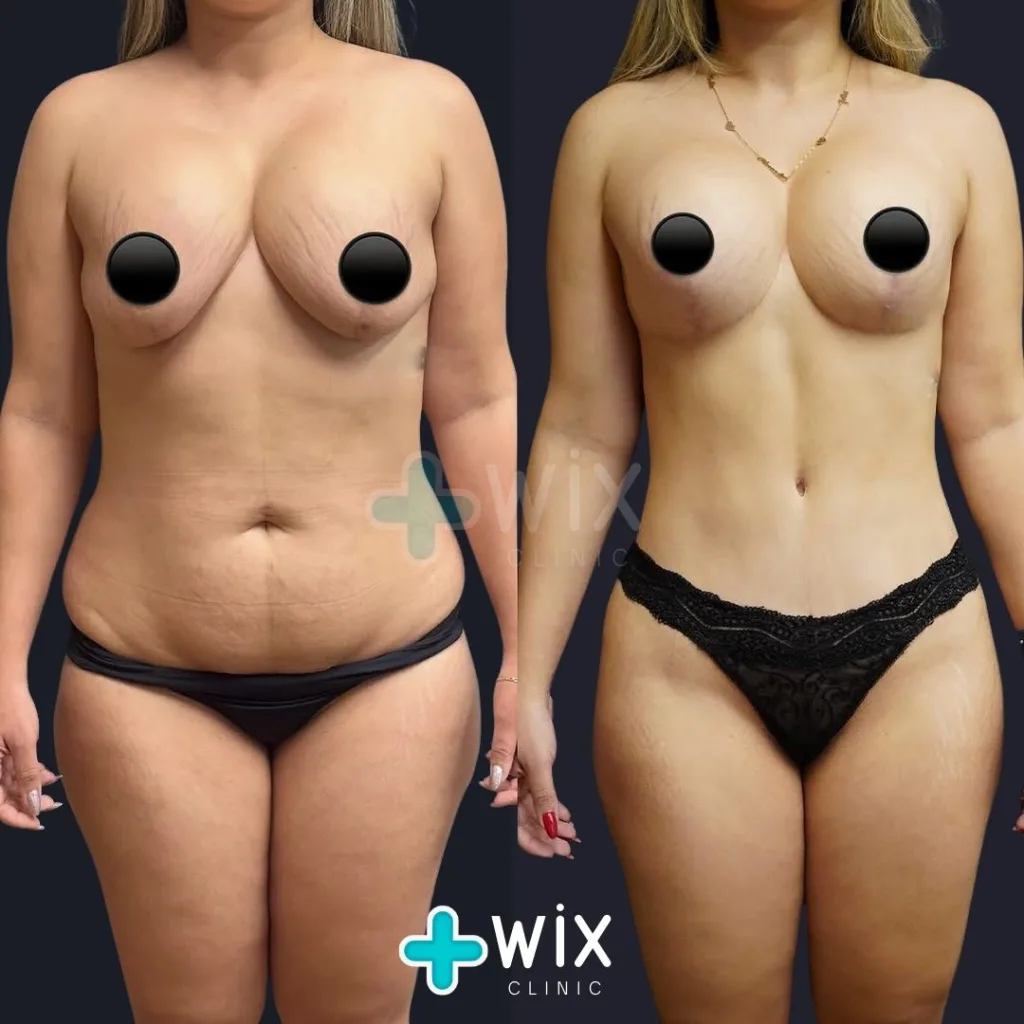 Liposuction Before and After