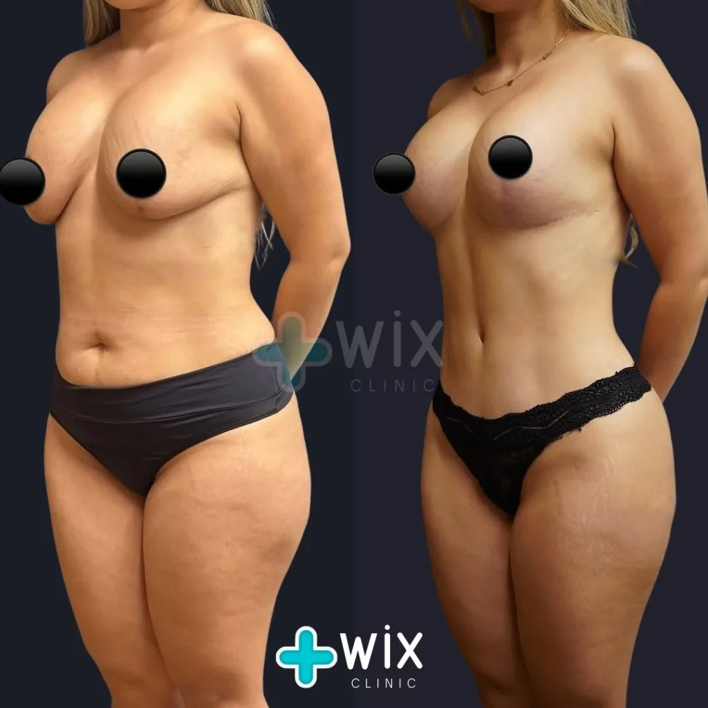 Liposuction Before and After