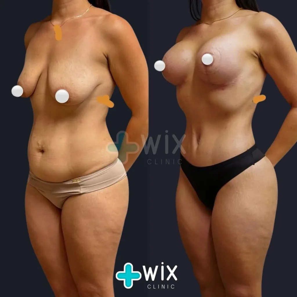 Liposuction Before and After