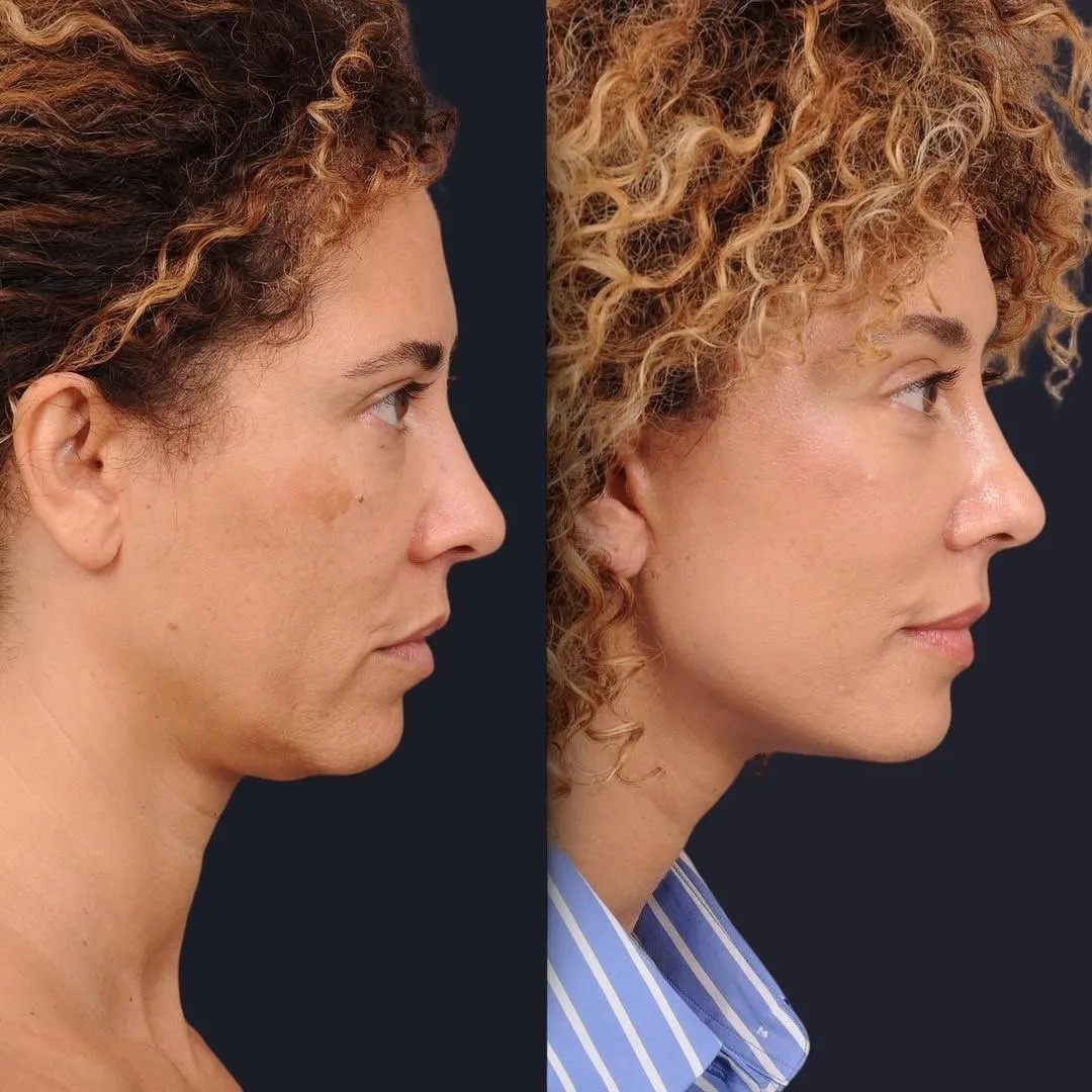 Neck Liposuction Before and After