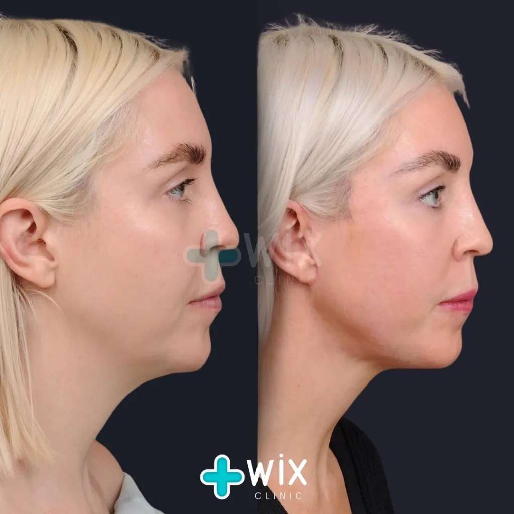 Neck Liposuction Before and After