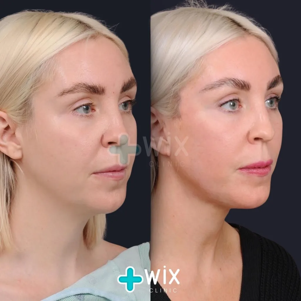 Neck Liposuction Before and After