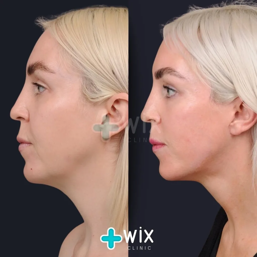 Neck Liposuction Before and After