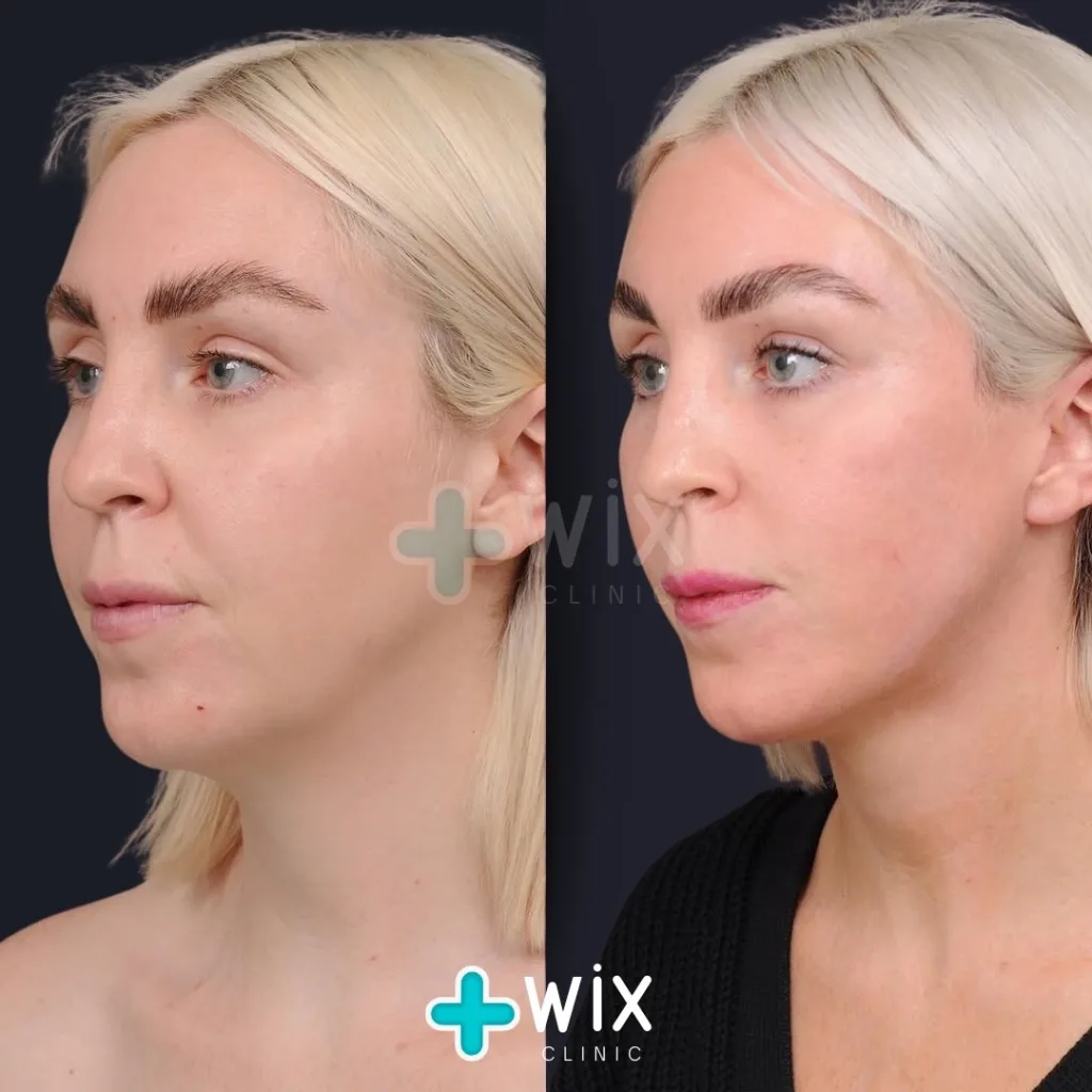 Neck Liposuction Before and After