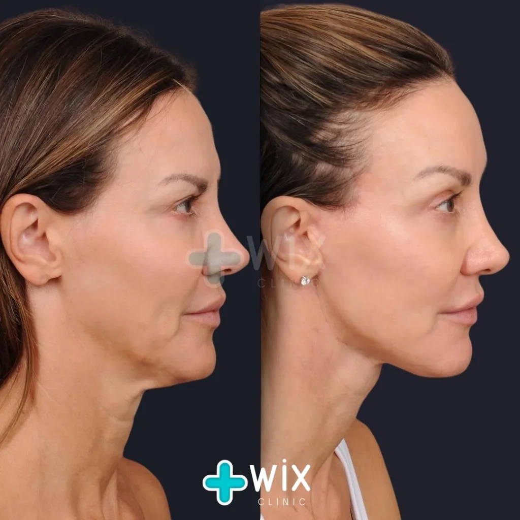 Neck Liposuction Before and After